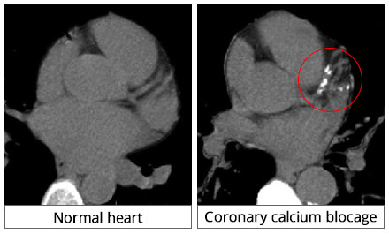 Coronary Calcium Scan in Manhattan NYC