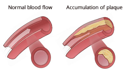 Stroke Screening NYC | Manhattan Cardiologists