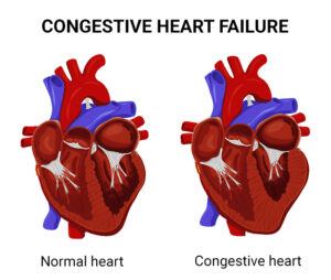 An Overview of Congestive Heart Failure | New York Cardiac Diagnostic ...