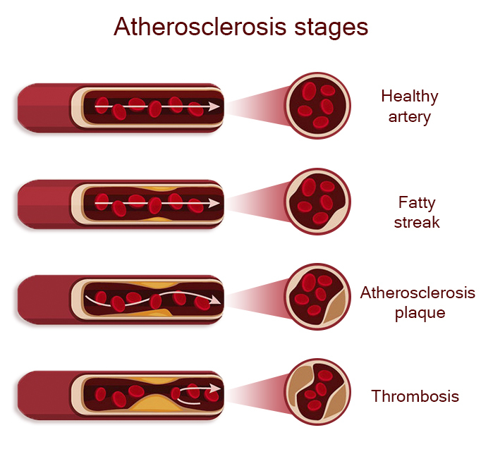 Vascular Screening