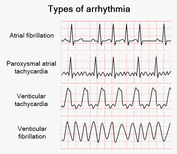 Arrhythmia