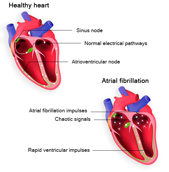 Atrial Fibrillation