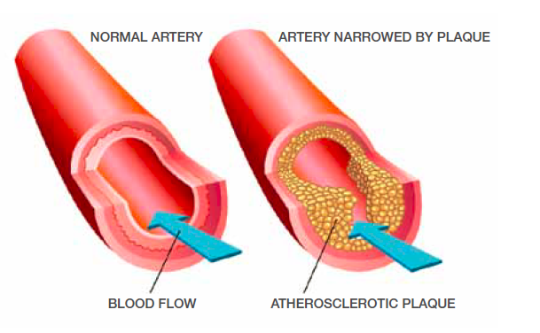 blocked-and-narrowed-arteries-what-this-means-for-your-heart-health