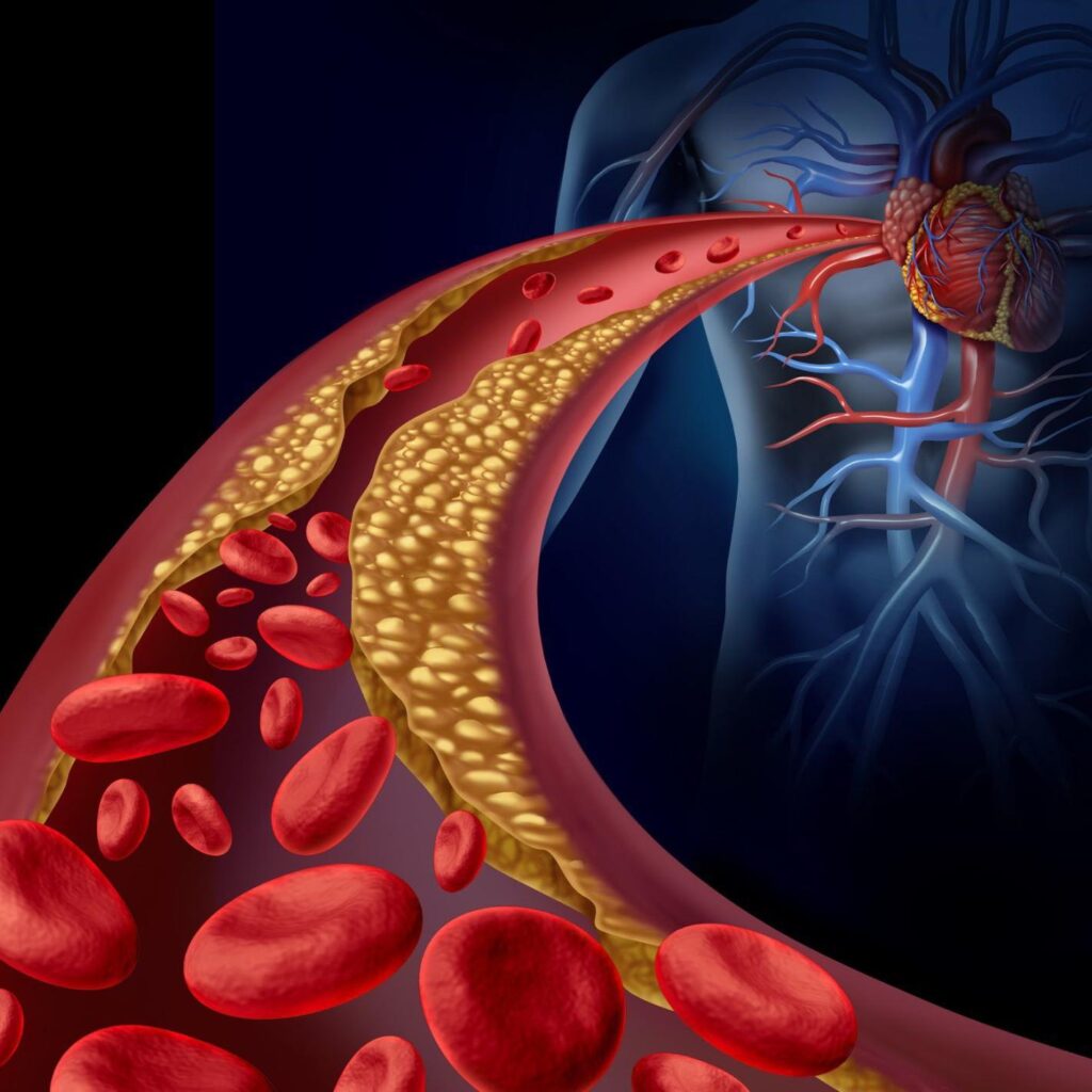 high-cholesterol