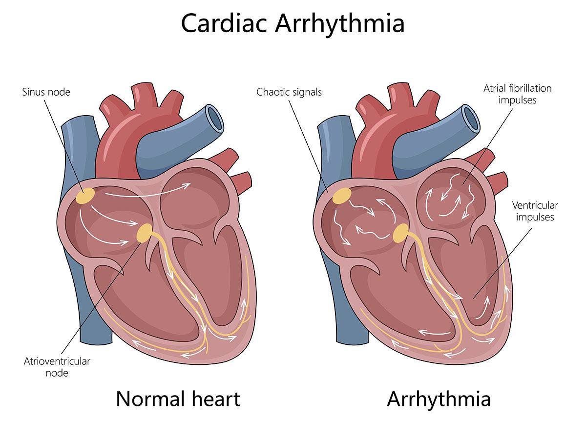 Heart Arrhythmia Treatment NYC