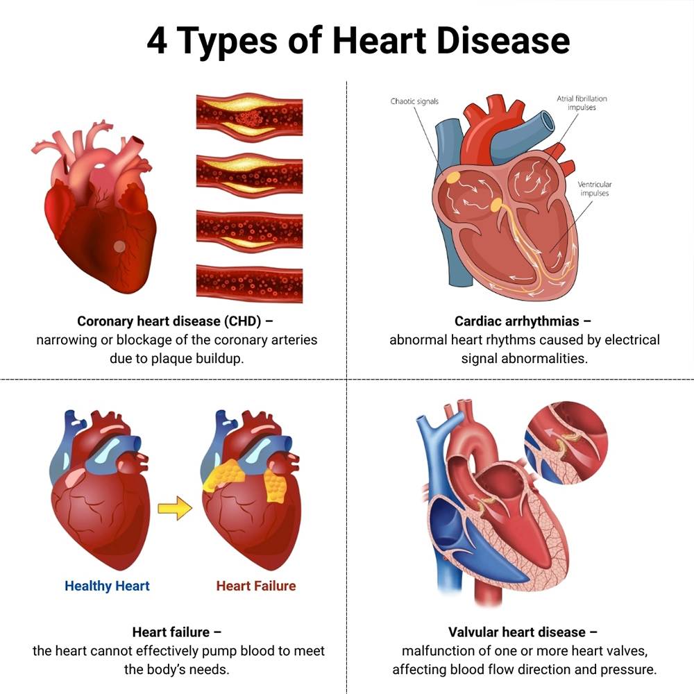 Types of Heart Disease